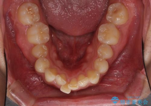インビザライン矯正とインプラント補綴　深い咬み合わせと奥歯の欠損治療の治療前