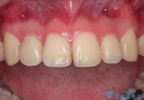 前歯が痛い。根管治療~セラミッククラウンの治療前