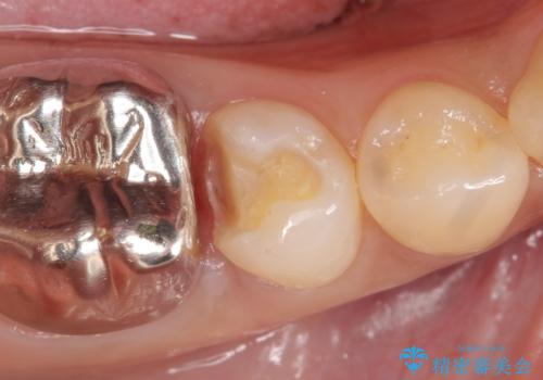 PGA(ゴールド)インレー　深い虫歯の虫歯の治療の治療中