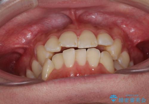 インビザラインで整った口元にの治療前