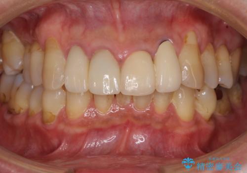 歯が痛い　前歯のセラミック治療の治療後