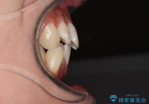 インビザラインで整った口元にの治療前