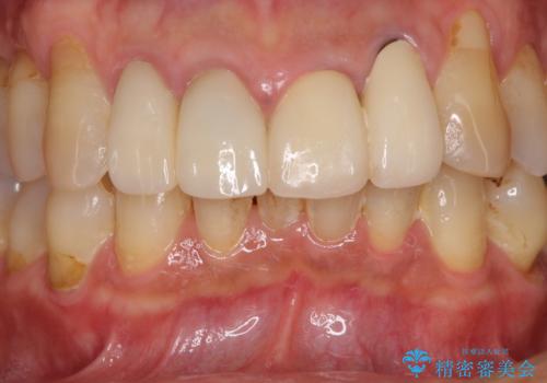 歯が痛い 前歯のセラミック治療の治療後