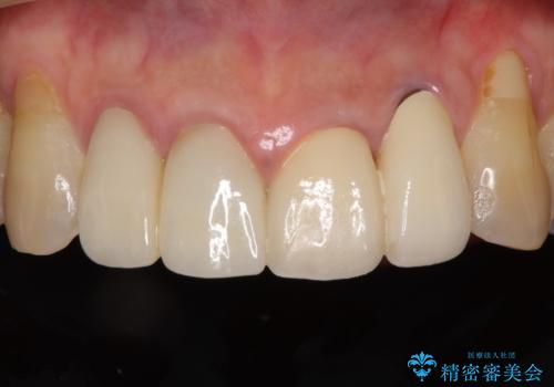 歯が痛い 前歯のセラミック治療