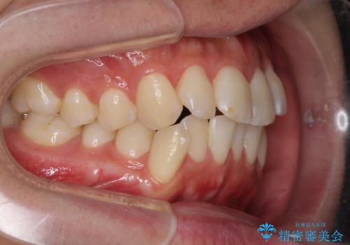 インビザラインで整った口元にの治療前