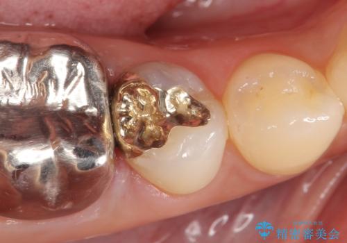 PGA(ゴールド)インレー　深い虫歯の虫歯の治療の治療後