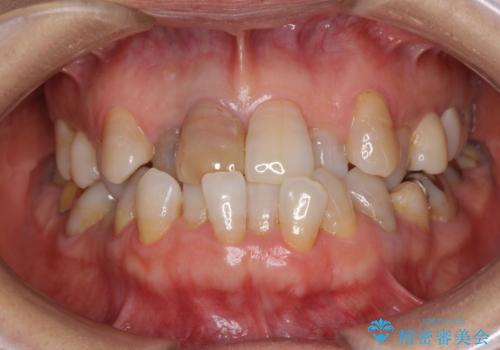変色した前歯のオールセラミック治療の治療前