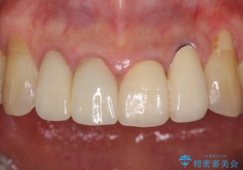 歯が痛い 前歯のセラミック治療の治療後