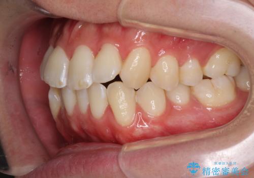 インビザラインで整った口元にの治療前