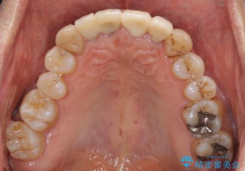 歯が痛い 前歯のセラミック治療の治療後