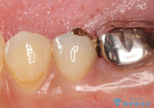 PGA(ゴールド)インレー 深い虫歯の虫歯の治療の治療後