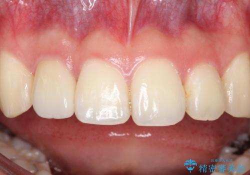 前歯が痛い。根管治療~セラミッククラウンの治療後