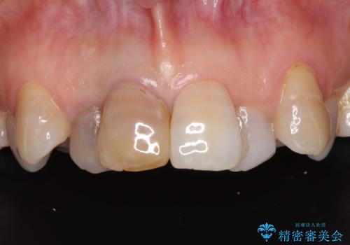 変色した前歯のオールセラミック治療の症例 治療前