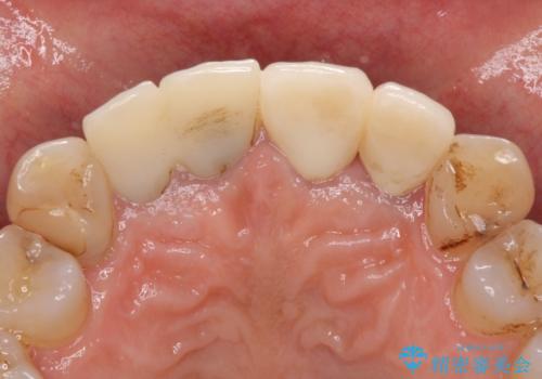 歯が痛い　前歯のセラミック治療の治療後