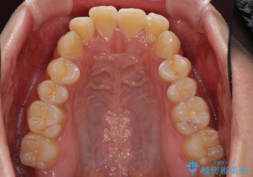 インビザラインで整った口元にの治療前