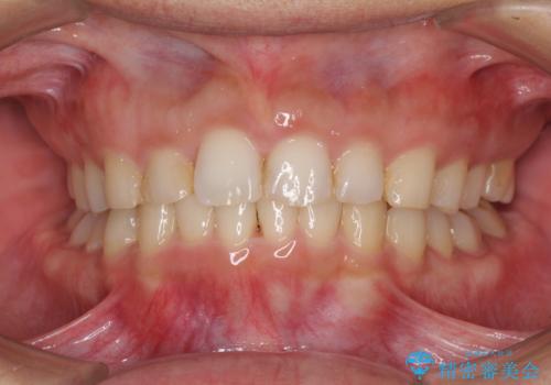 インビザライン矯正とインプラント補綴 深い咬み合わせと奥歯の欠損治療の治療中