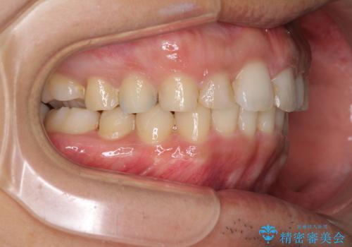 インビザライン矯正とインプラント補綴 深い咬み合わせと奥歯の欠損治療の治療中