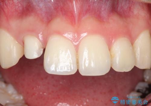 前歯が痛い。根管治療~セラミッククラウンの治療中