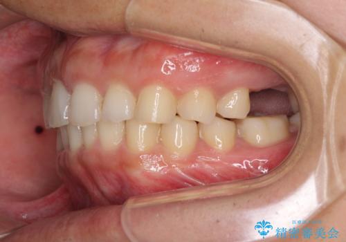 インビザライン矯正とインプラント補綴 深い咬み合わせと奥歯の欠損治療の治療中