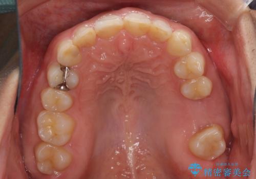 インビザライン矯正とインプラント補綴 深い咬み合わせと奥歯の欠損治療の治療中