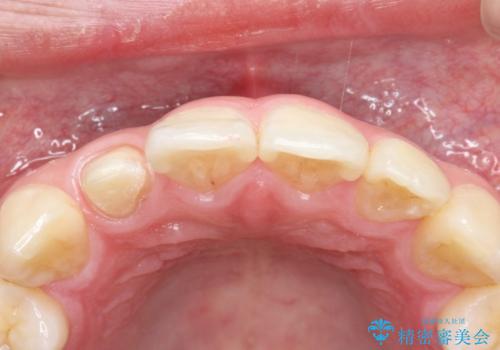 前歯が痛い。根管治療~セラミッククラウンの治療中