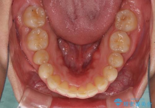 インビザライン矯正とインプラント補綴 深い咬み合わせと奥歯の欠損治療の治療中