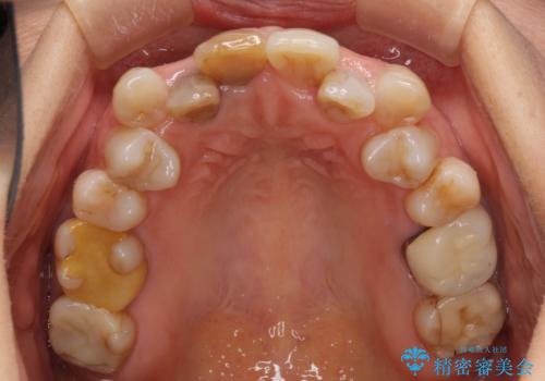 変色した前歯のオールセラミック治療の治療前
