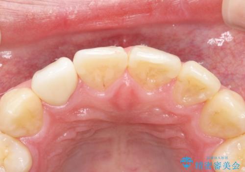 前歯が痛い。根管治療~セラミッククラウンの治療後