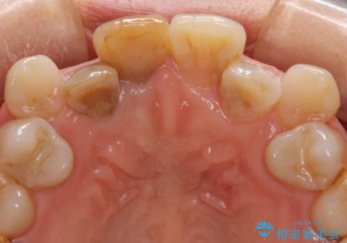 変色した前歯のオールセラミック治療の治療前