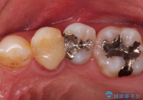 深いむし歯。根本的な治療の症例 治療前