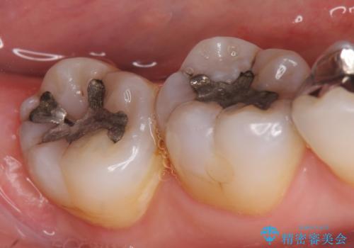 セラミックインレー 古い銀歯をやり直したいの治療前