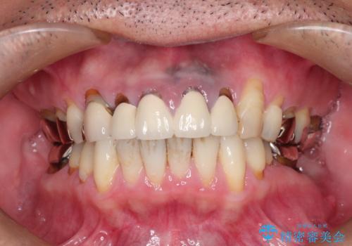 上の前歯の根元が黒い　根の治療を含めたセラミック再治療の症例 治療前