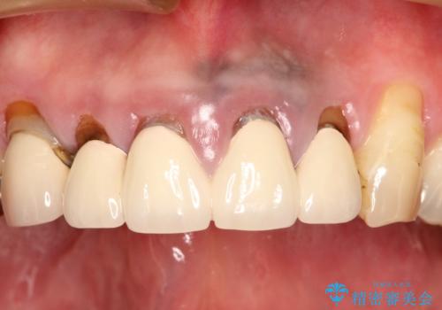 上の前歯の根元が黒い 根の治療を含めたセラミック再治療の治療前