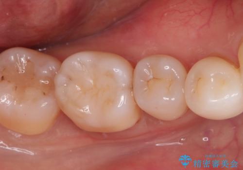 治療したむし歯の再治療。セラミックにしたい!の治療後