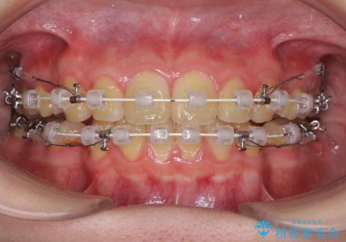 口元が出てるの気になる、引っ込めたい ワイヤーによる抜歯矯正で横顔の改善の治療中