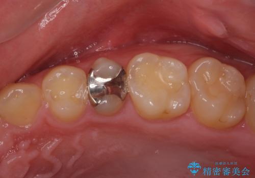 割れた歯を引っ張り出す　右上と左上の虫歯治療の治療前