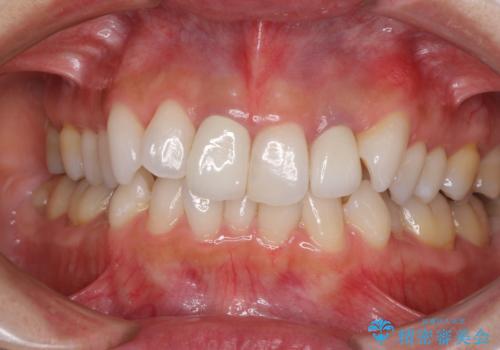 裏打ちが金属のセラミッククラウンをオールセラミッククラウンで自然にの治療後