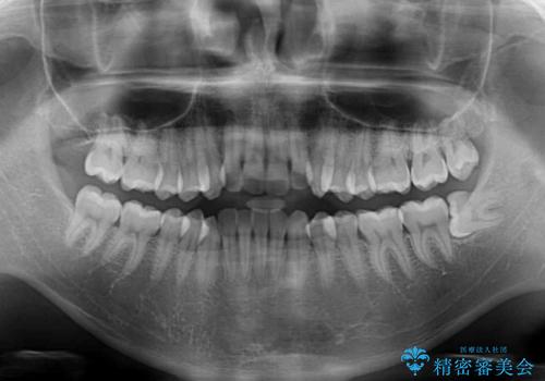インビザラインで整った口元にの治療前