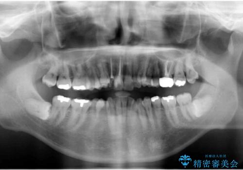 奥に引っ込んでいる歯をセラミックでかぶせたい 補綴前矯正 50代男性の治療前