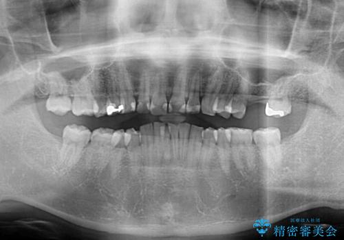 インビザライン矯正とインプラント補綴 深い咬み合わせと奥歯の欠損治療の治療前