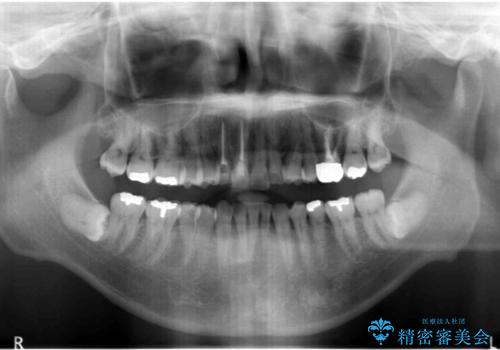 奥に引っ込んでいる歯をセラミックでかぶせたい 補綴前矯正 50代男性の治療後