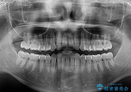 インビザラインで整った口元にの治療後