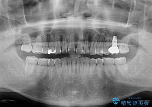 インビザライン矯正とインプラント補綴　深い咬み合わせと奥歯の欠損治療の治療後