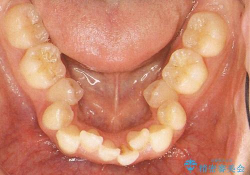 前歯のガタガタと出っ歯が気になる ハーフリンガルによる抜歯矯正の治療前
