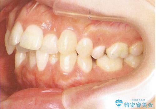 前歯のガタガタと出っ歯が気になる　ハーフリンガルによる抜歯矯正の治療前