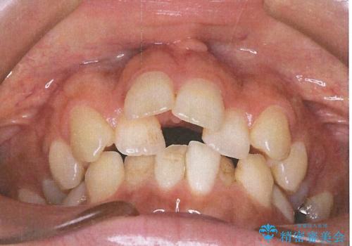 前歯のガタガタと出っ歯が気になる ハーフリンガルによる抜歯矯正の治療前
