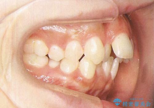 前歯のガタガタと出っ歯が気になる　ハーフリンガルによる抜歯矯正の症例 治療前