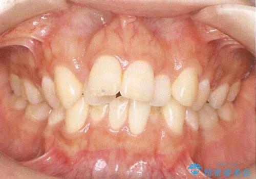 前歯のガタガタと出っ歯が気になる ハーフリンガルによる抜歯矯正の治療前