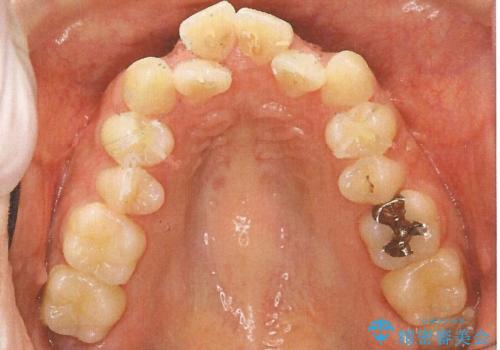 前歯のガタガタと出っ歯が気になる　ハーフリンガルによる抜歯矯正の治療前