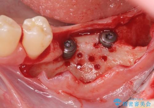 臼歯の噛み合わせをインプラントを用いて回復するの治療中